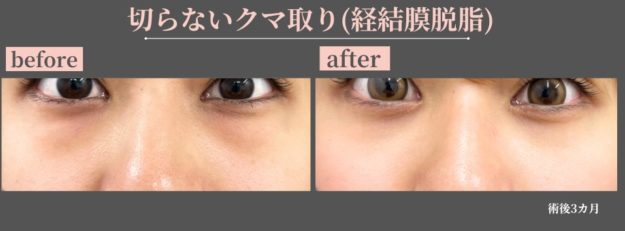 クマ取り治療　症例写真　経結膜脱脂