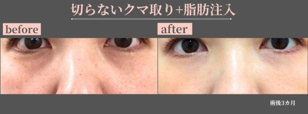 クマ取り治療　症例写真　経結膜脱脂+脂肪注入