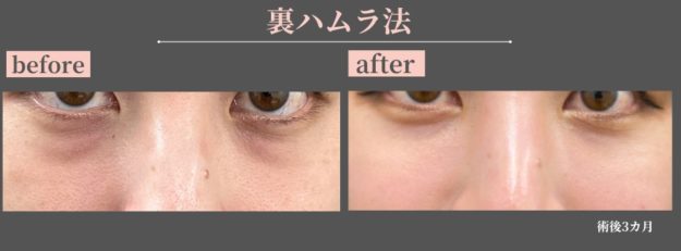 クマ取り治療　症例写真 裏ハムラ