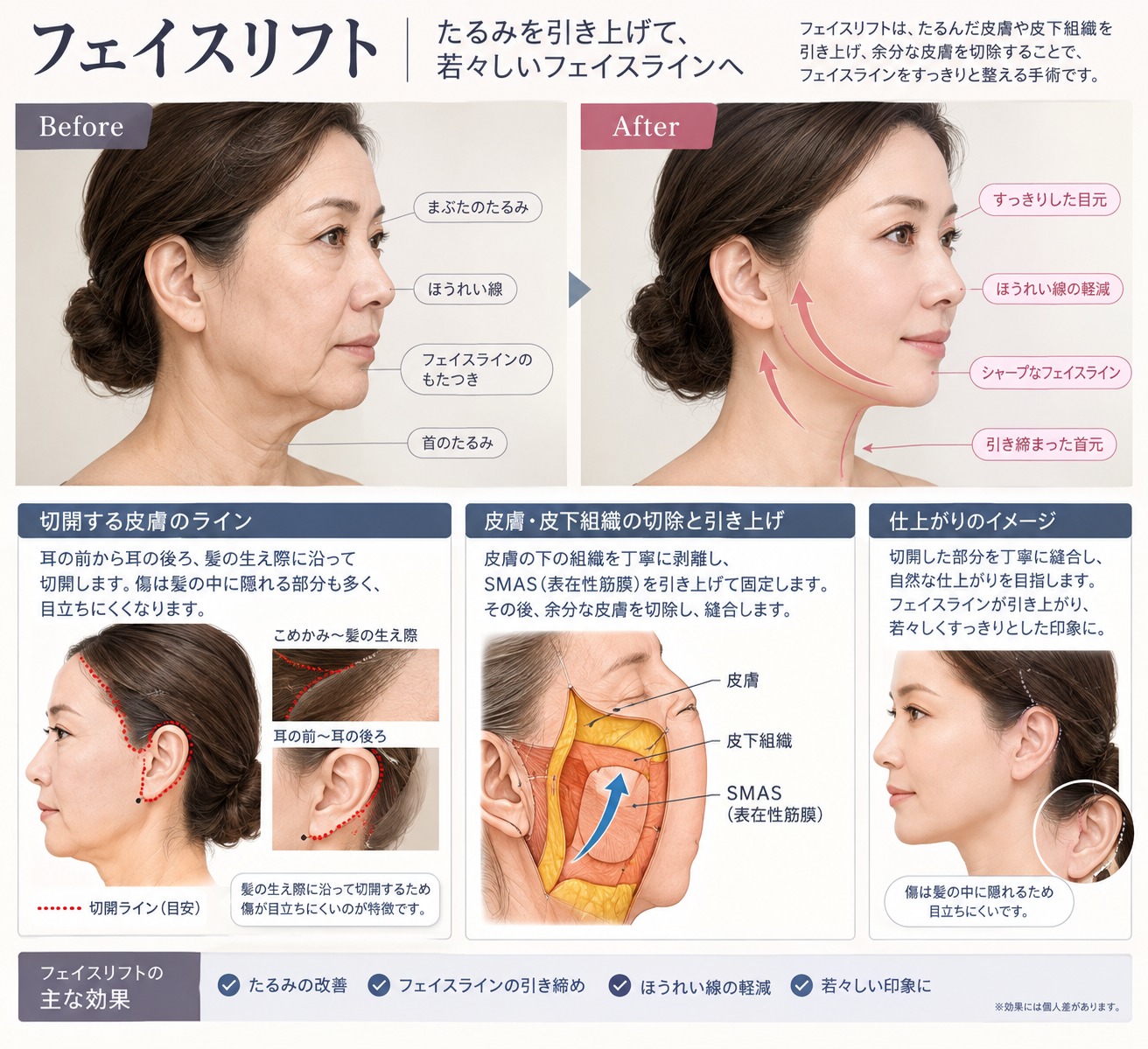 フェイスリフトの治療内容が良くわかる画像